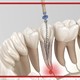 ایمنی و نکات کلیدی کار با فایل‌های روتاری در درمان ریشه